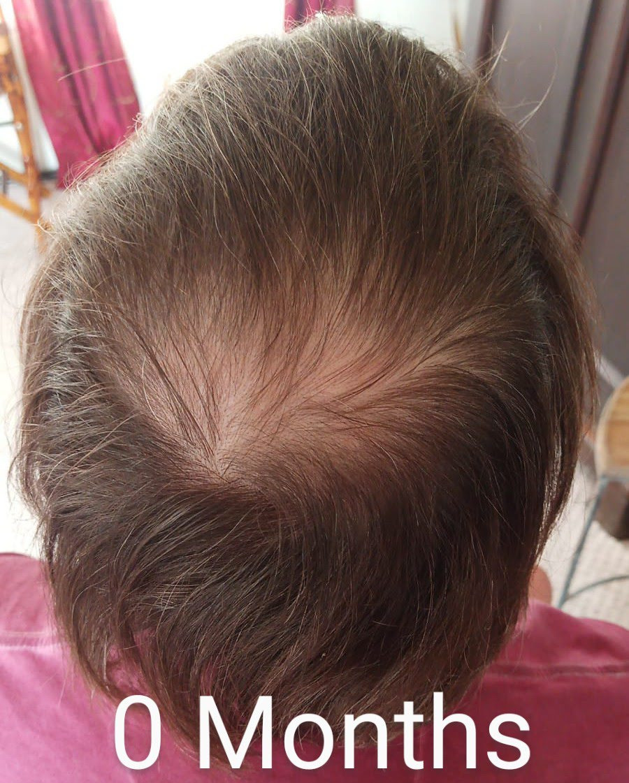 Amazon Basic Care Minoxidil Topical Solution USP, 5 Percent, Hair Regrowth Treatment for Men, Extra Strength, 12 Fluid Ounces Customer Review Amazon Basic Care Minoxidil Topical Solution USP, 5 Percent, Hair Regrowth Treatment for Men, Extra Strength, 12 Fluid Ounces - Customer Photo 2