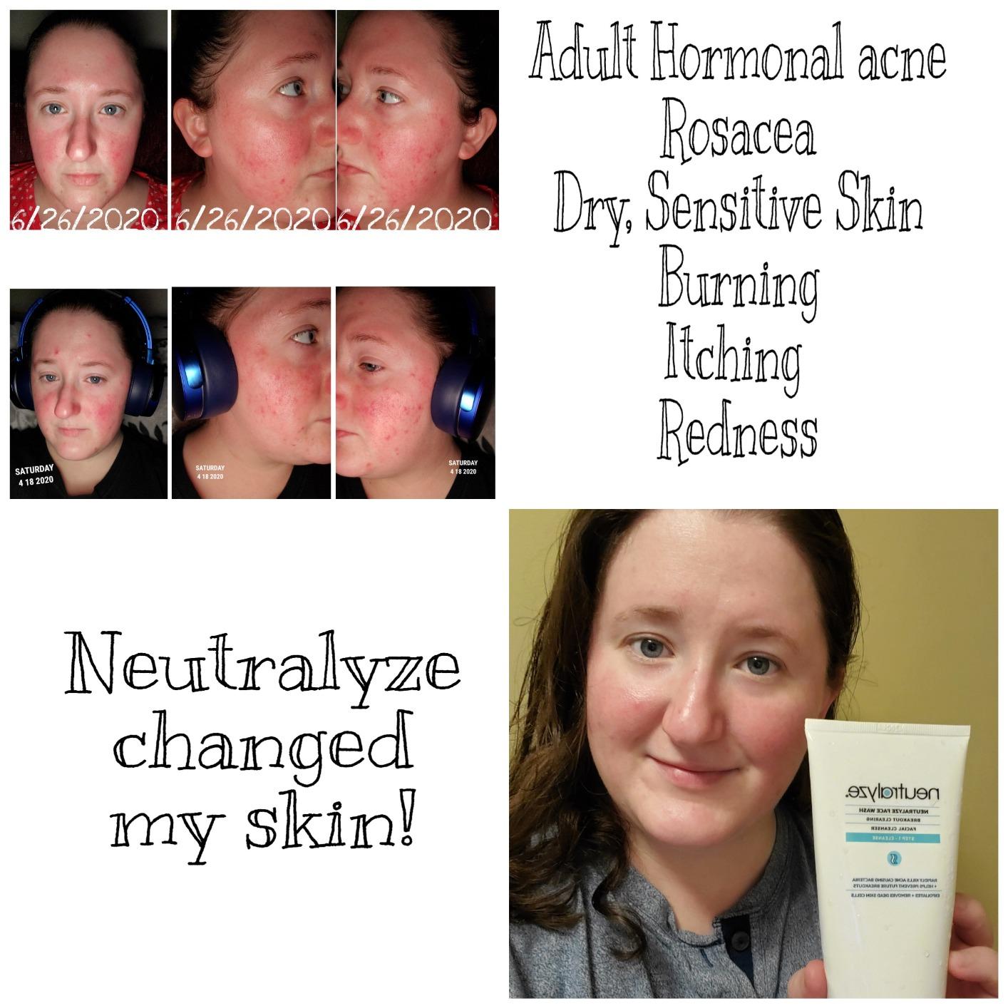Neutralyze Moderate to Severe Acne Treatment Kit 2.0 - Maximum Strength 3 Step Acne Kit with 2% Salicylic Acid, 2% Mandelic Acid & Nitric Oxide - Includes Face Wash, Clearing Serum & Synergyzer Customer Review Neutralyze Moderate to Severe Acne Treatment Kit 2.0 - Maximum Strength 3 Step Acne Kit with 2% Salicylic Acid, 2% Mandelic Acid & Nitric Oxide - Includes Face Wash, Clearing Serum & Synergyzer - Customer Photo 2
