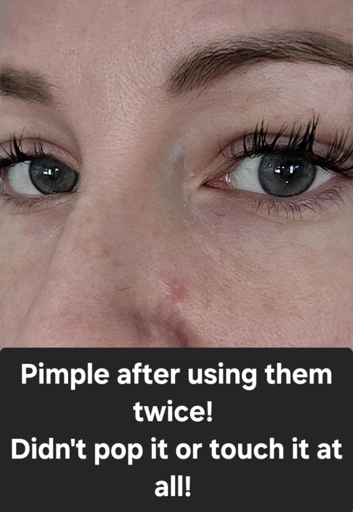 MAREE Star Pimple Patches for Face - Hydrocolloid Acne Patches w/Salicylic Acid, Tea Tree Oil & Centella - Cute Pimple Patches Stars - Teens Zit Patches Stickers - Parches Para Acne - 72 Blemish Dots Customer Review MAREE Star Pimple Patches for Face - Hydrocolloid Acne Patches w/Salicylic Acid, Tea Tree Oil & Centella - Cute Pimple Patches Stars - Teens Zit Patches Stickers - Parches Para Acne - 72 Blemish Dots - Customer Photo 2
