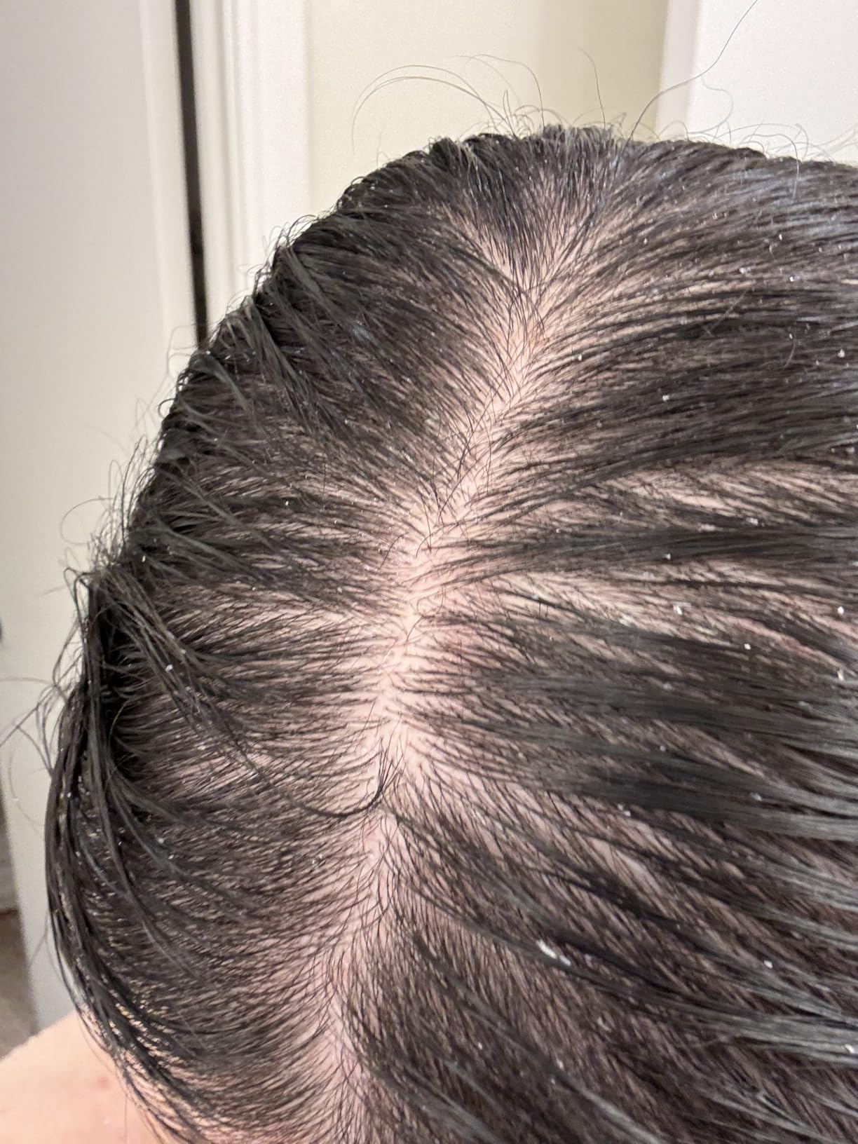OUAI Anti Dandruff Shampoo - Soothing Salicylic Acid Shampoo for Flaky, Dry and Itchy Scalp - Reduces Itching, Redness and Irritation - Sulfate Free Scalp Care (10 Fl Oz) - Customer Photo 1