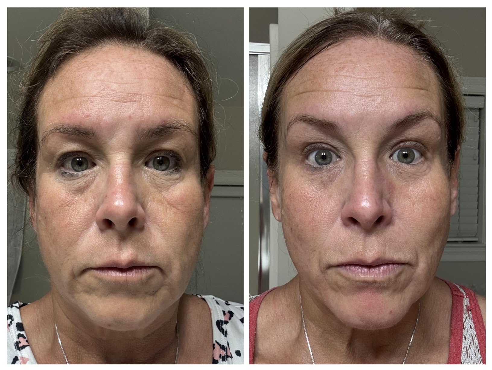 The Ordinary Matrixyl 10% + Hyaluronic Acid, Anti-Aging Serum for Fine Lines and Wrinkles, 1 Fl Oz customer photo 2