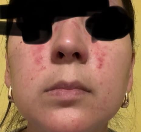 Roycederm Rosacea Treatment for Face with Azelaic Acid - Redness Relief & Corrector - Sensitive Skin Moisturizer for Redness, Bumps & Irritation with Sulphur, Niacinamide, Centella & Ceramides customer photo 2
