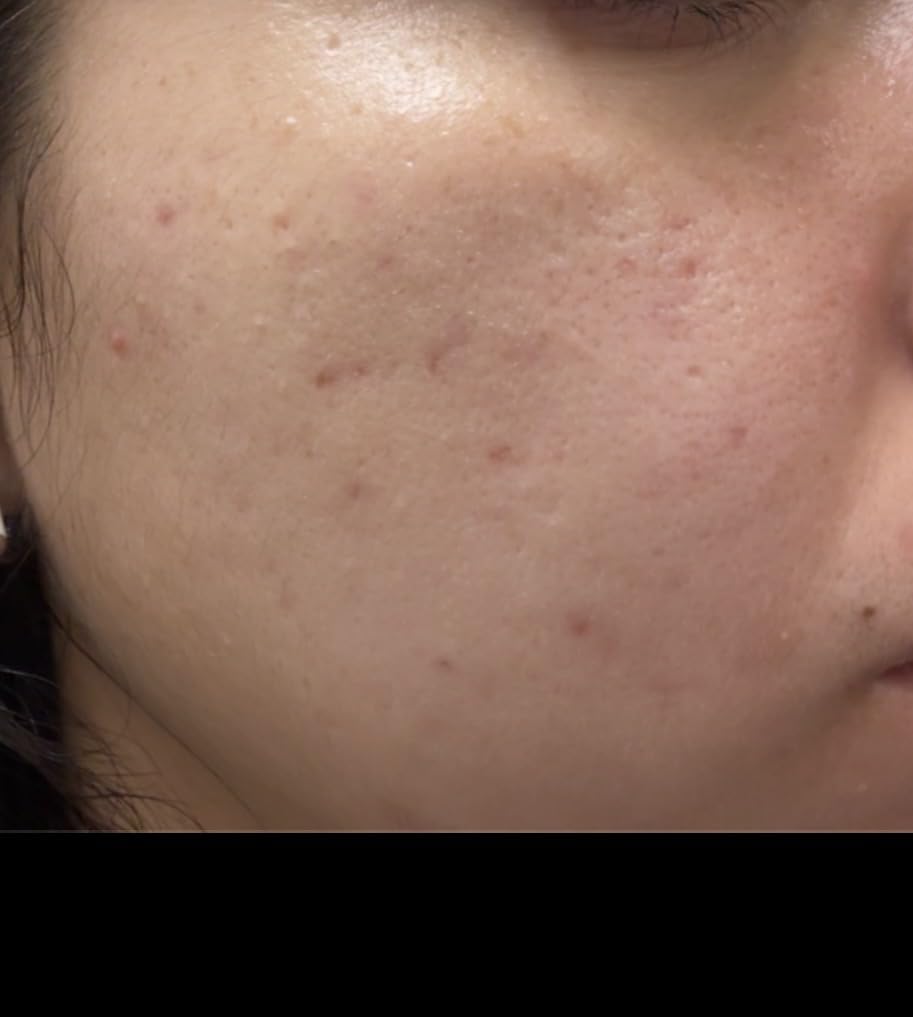 Good Molecules 10% Azelaic Acid Treatment for Face - Blurs Facial Redness & Evens Skin Tone - Brightens the Look of Dark Spots & Refines Texture - Vegan & Fragrance-Free Skincare (30ml / 1.01 fl oz.) customer photo 2