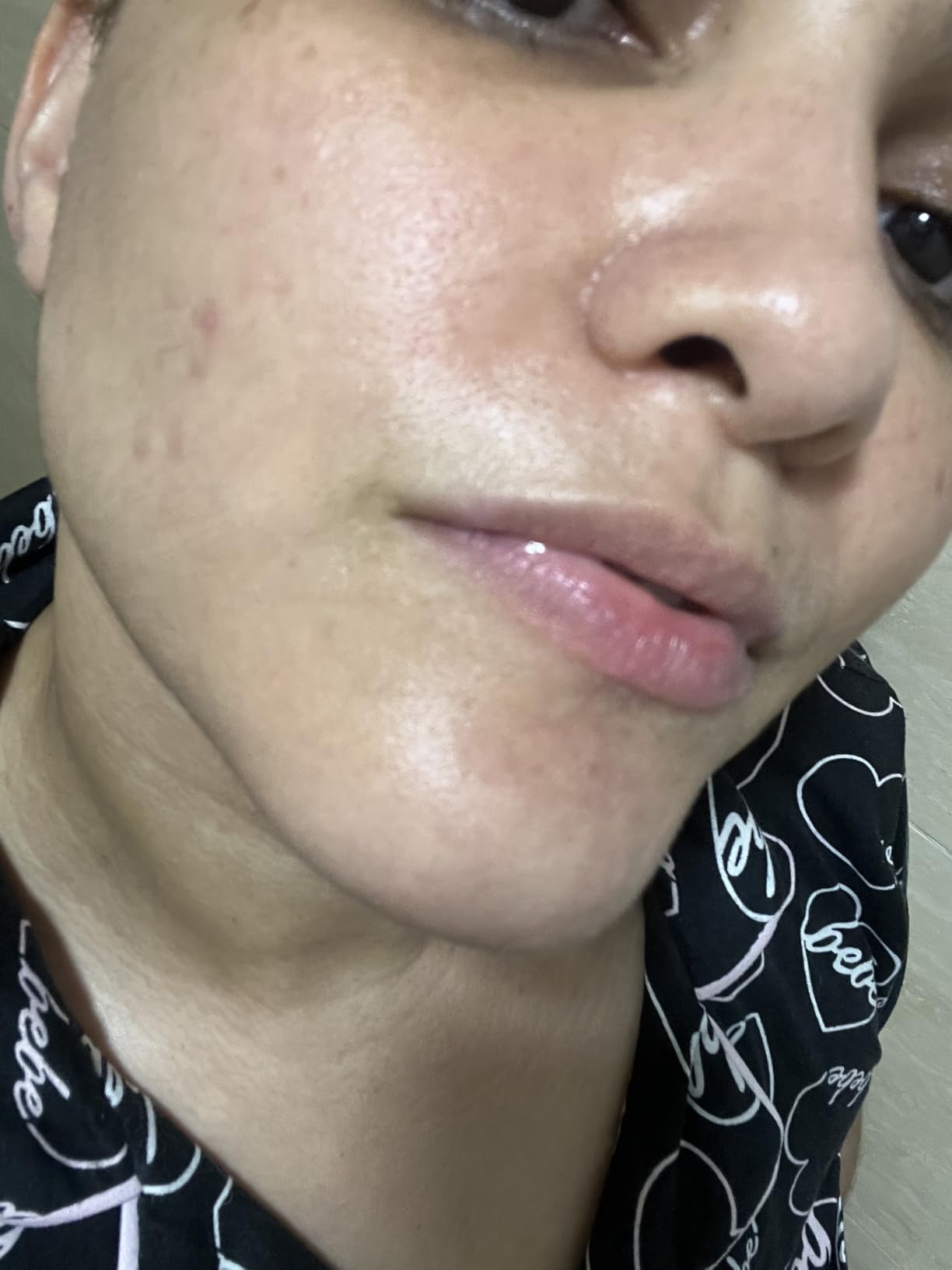 suquato 10% Azelaic Acid Cream - Rosacea Treatment for Face & Redness Reducing Face Cream - Redness & Blemish Care for Sensitive Skin - Lightweight Daily Use 30g customer photo 1